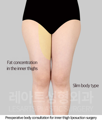 thigh_liposuction_02_01_250814