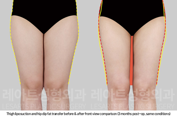 thigh_liposuction_02_02_250826