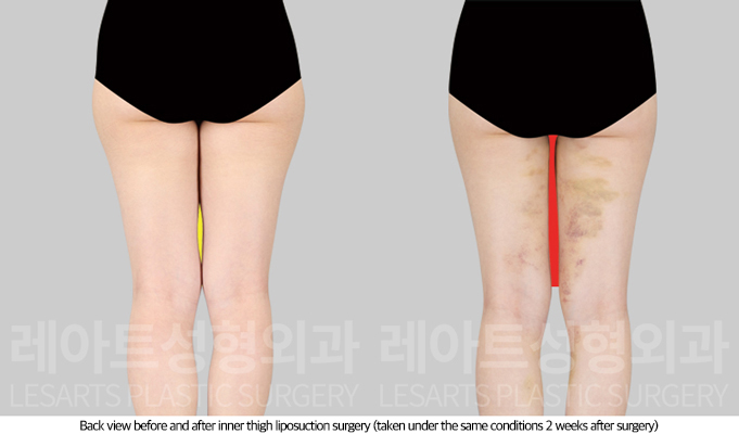 thigh_liposuction_02_04_250814
