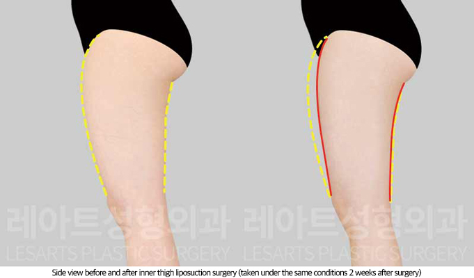 thigh_liposuction_02_05_250814