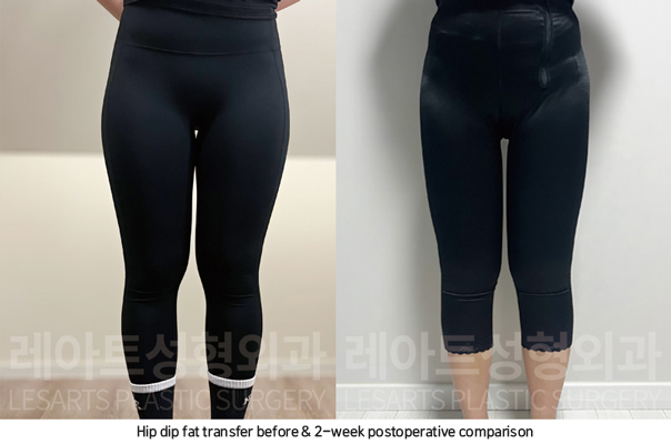 thigh_liposuction_02_05_250826