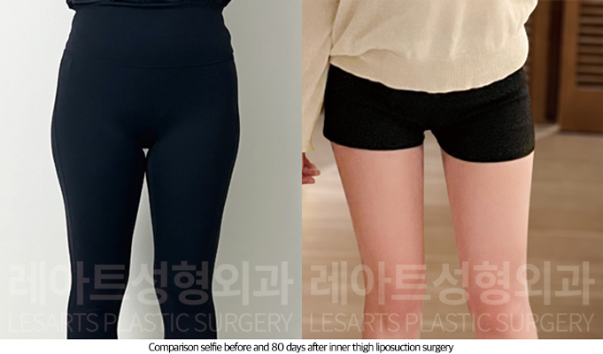 thigh_liposuction_02_06_250814