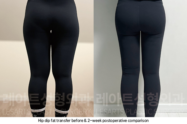 thigh_liposuction_02_06_250826