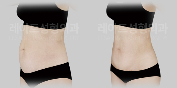 tummy_tuck_01_thumbnail_250818