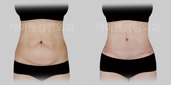 tummy_tuck_01_thumbnail_250901