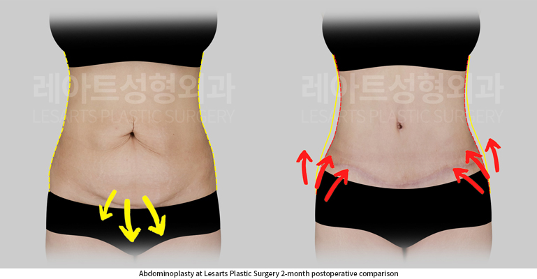 tummy_tuck_02_03_250901