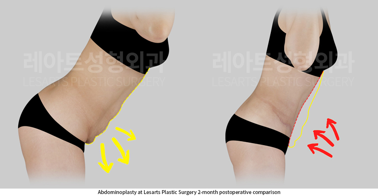 tummy_tuck_02_04_250901