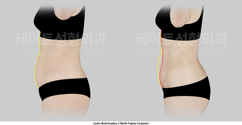 tummy_tuck_02_05_250818