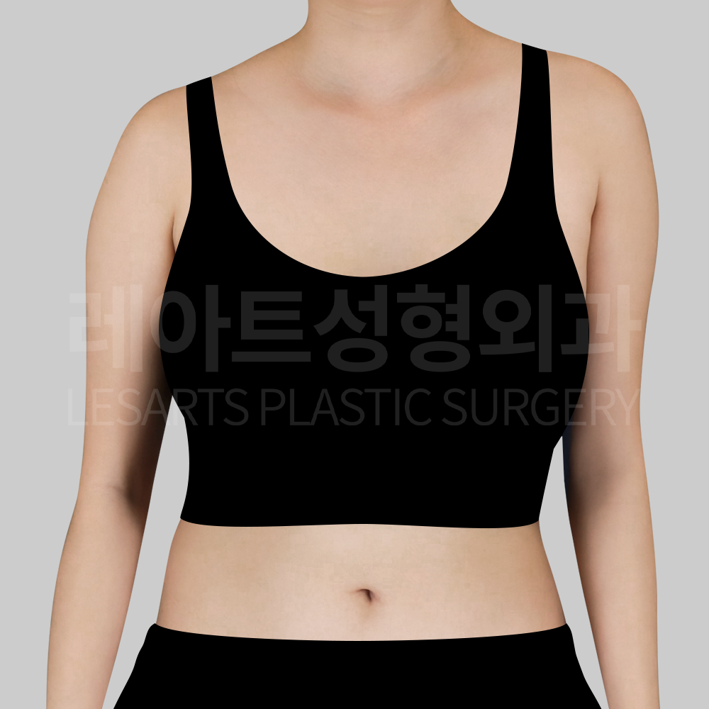 1-1.29696_arm_liposuction_fornt