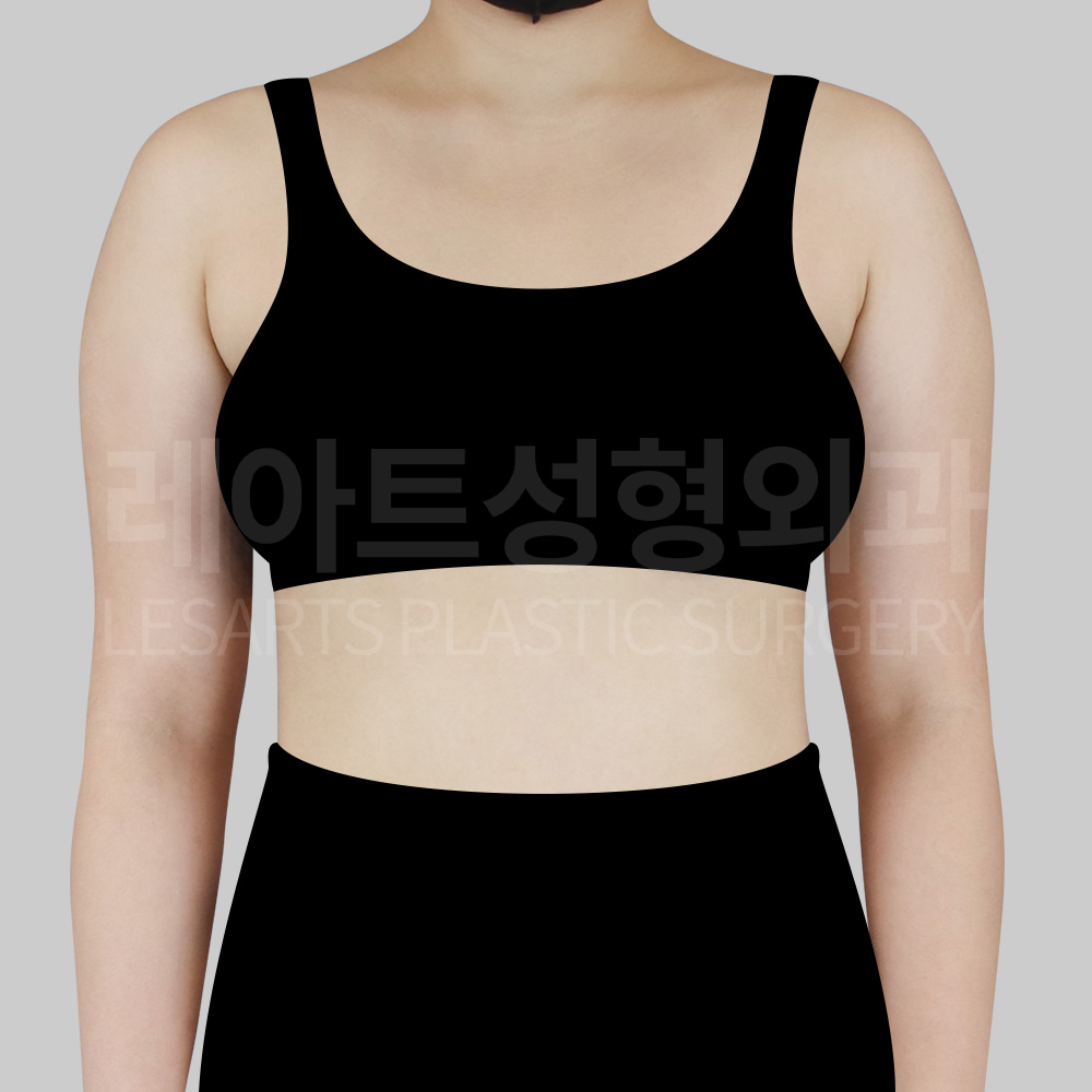 1-1_28996__armliposuction_before_01