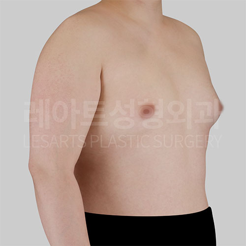 1-1_gynecomastia-_30268_before