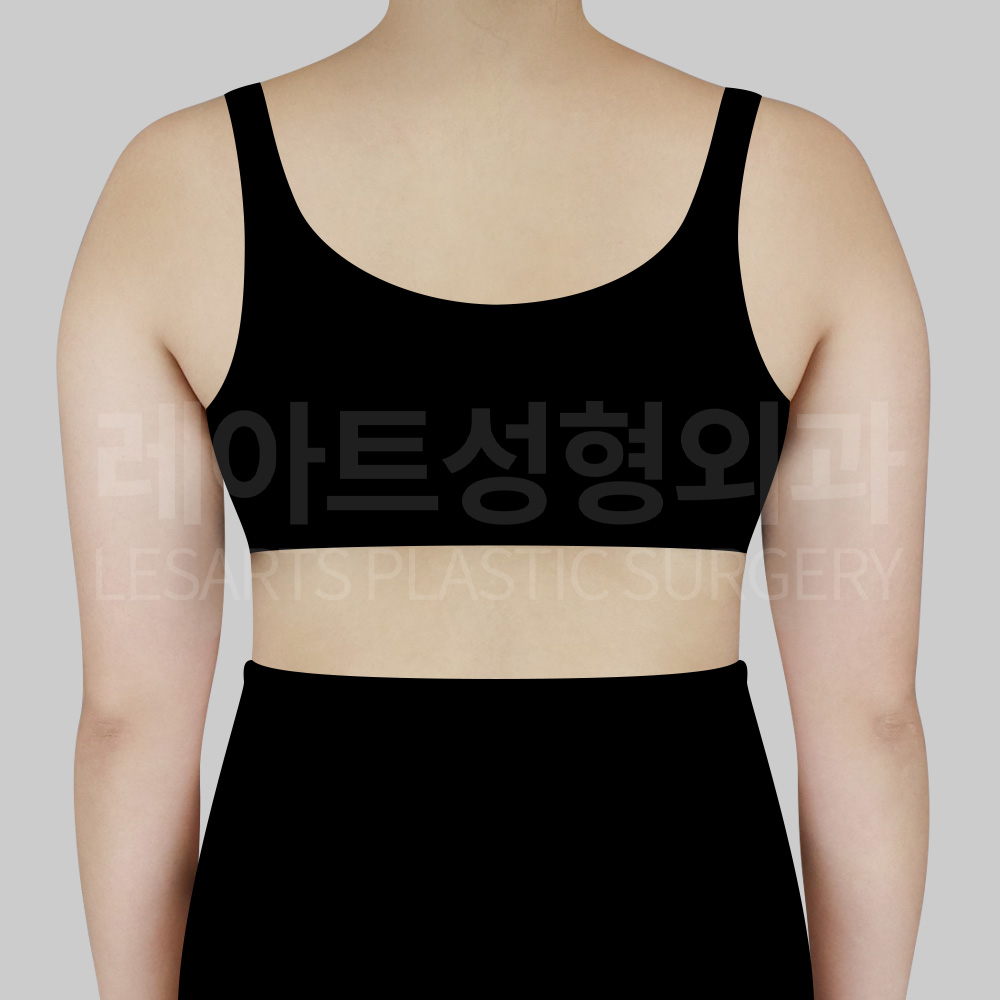 1-228996__armliposuction_before_02