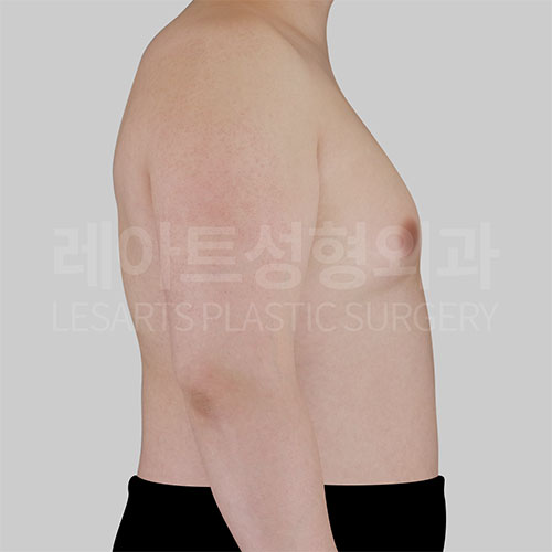 1-2_gynecomastia-_30268_before