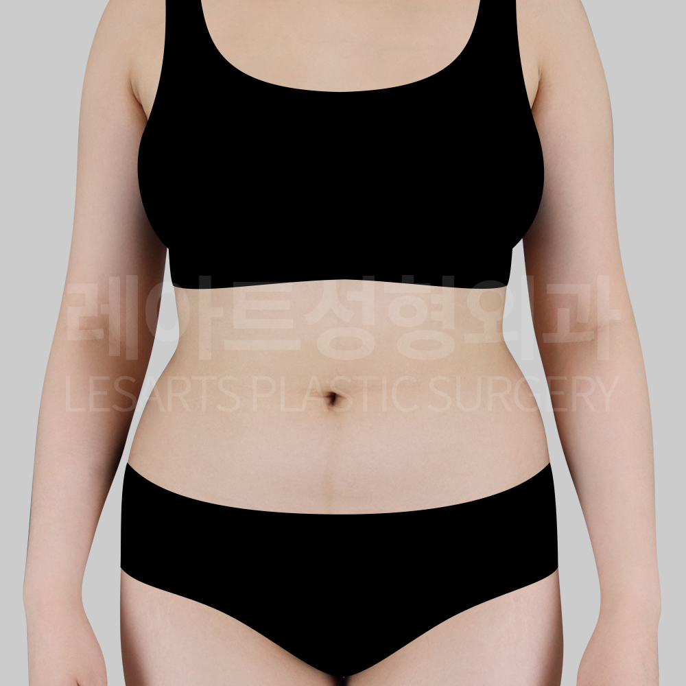 1.abdominal_liposuction_29377_front