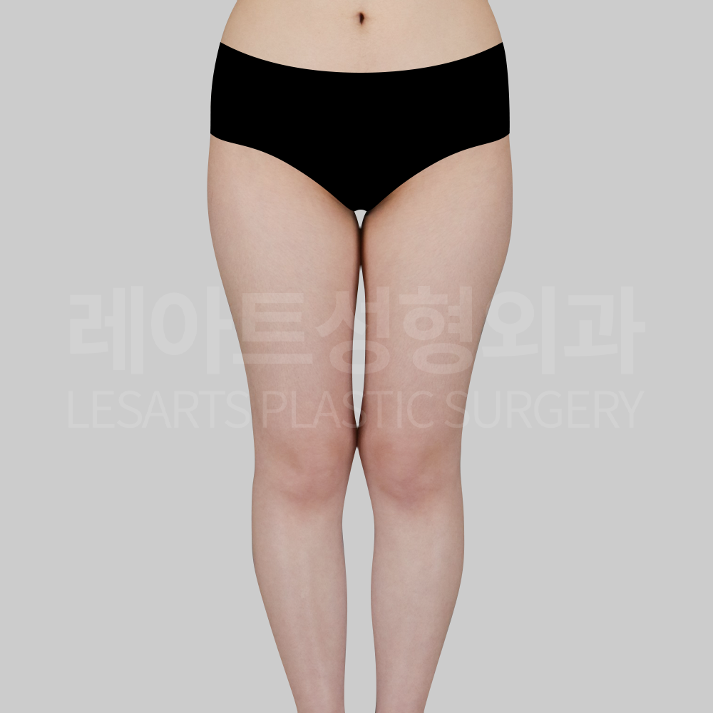 1.thigh_liposuction_29936_front
