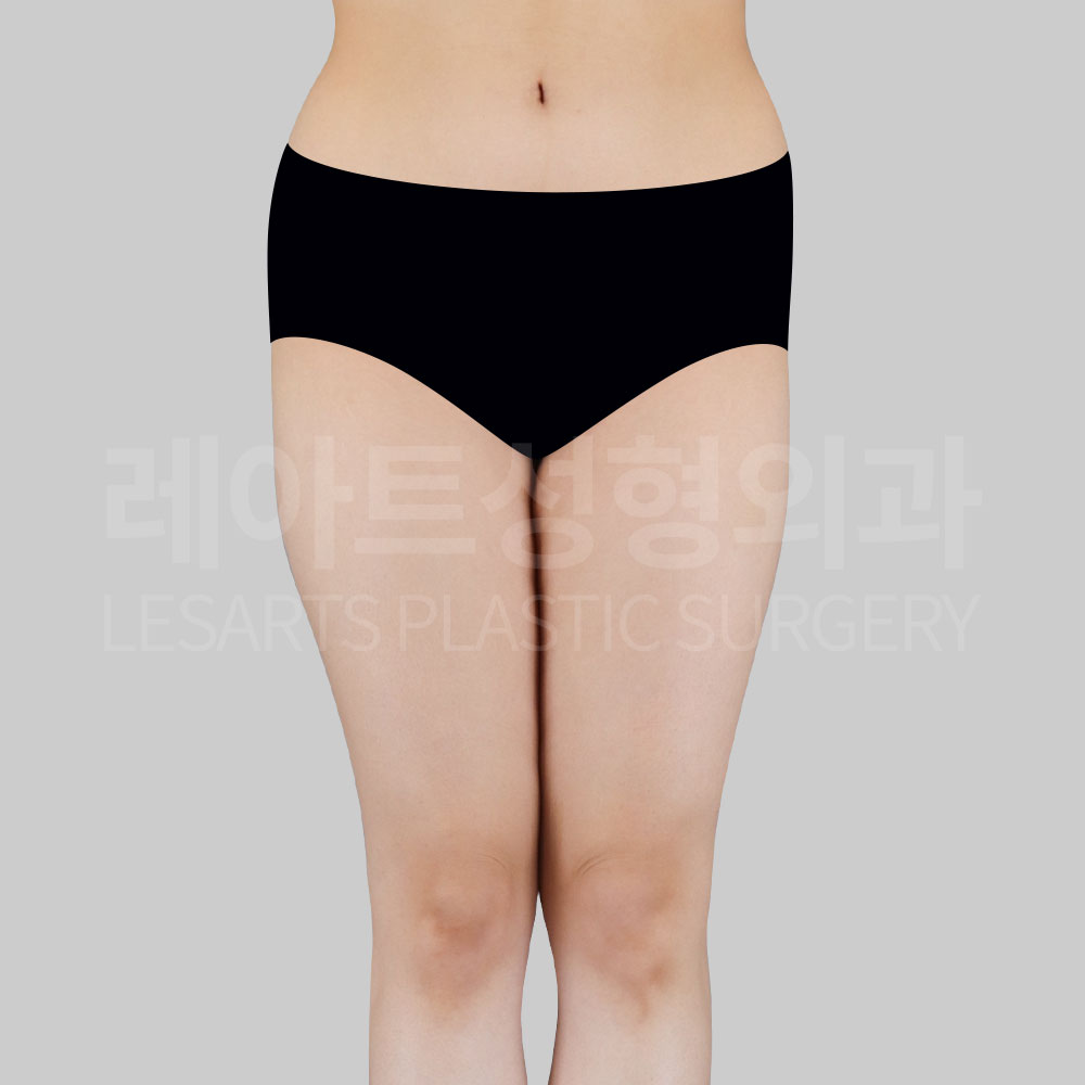 1_28695_thigh_liposuction_before