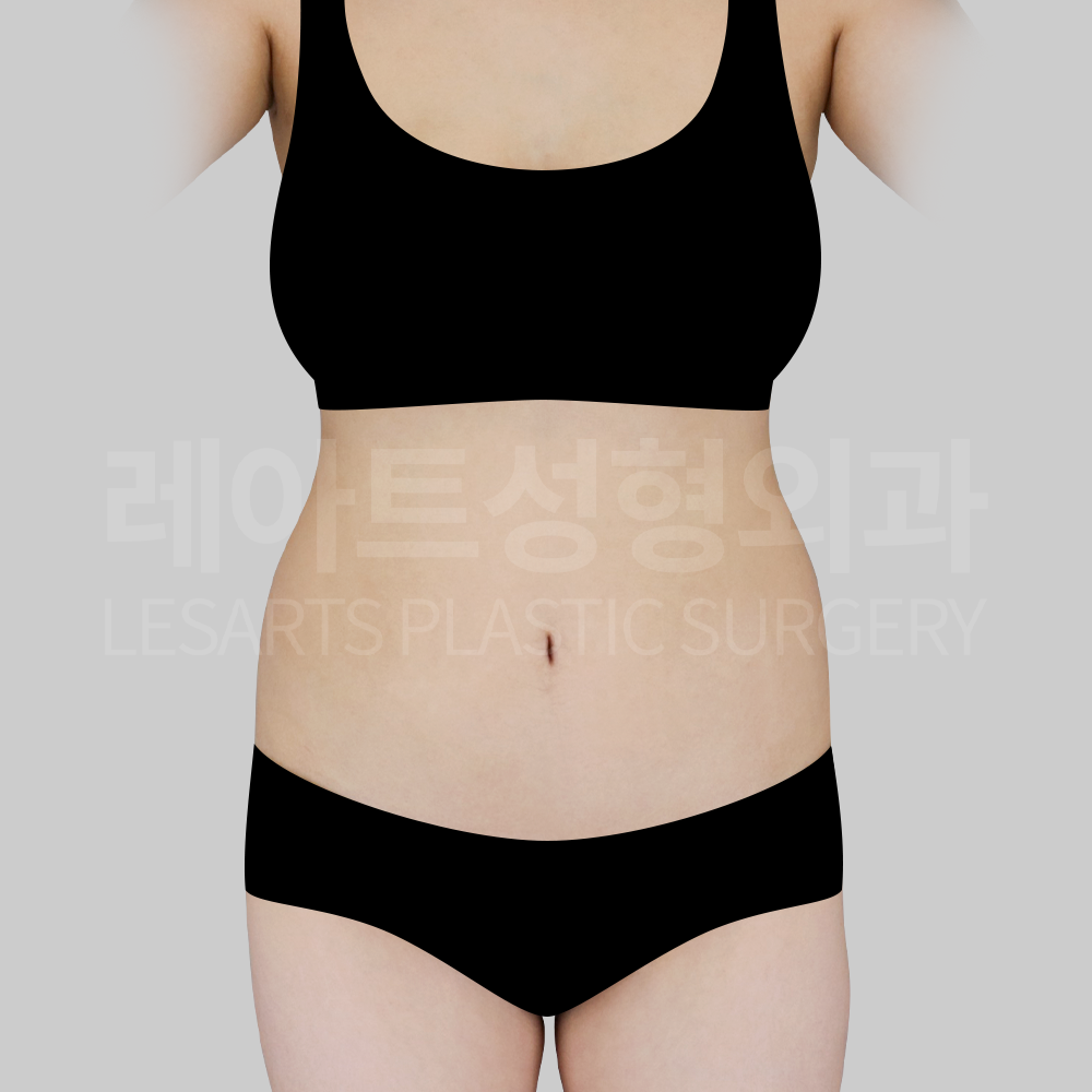 1_29214_abdominal_liposuction