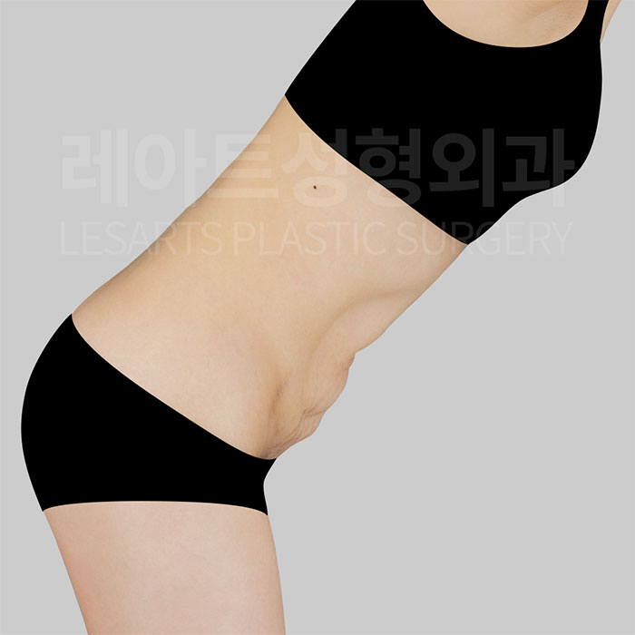 2-abdominoplasty-30075-before