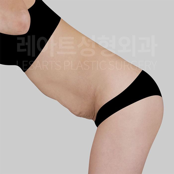 2-abdominoplasty-31233-before