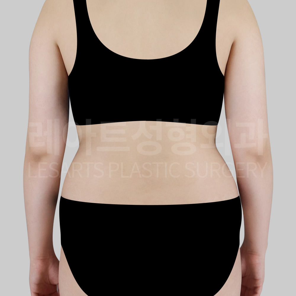 2.abdominal_liposuction_29377_back