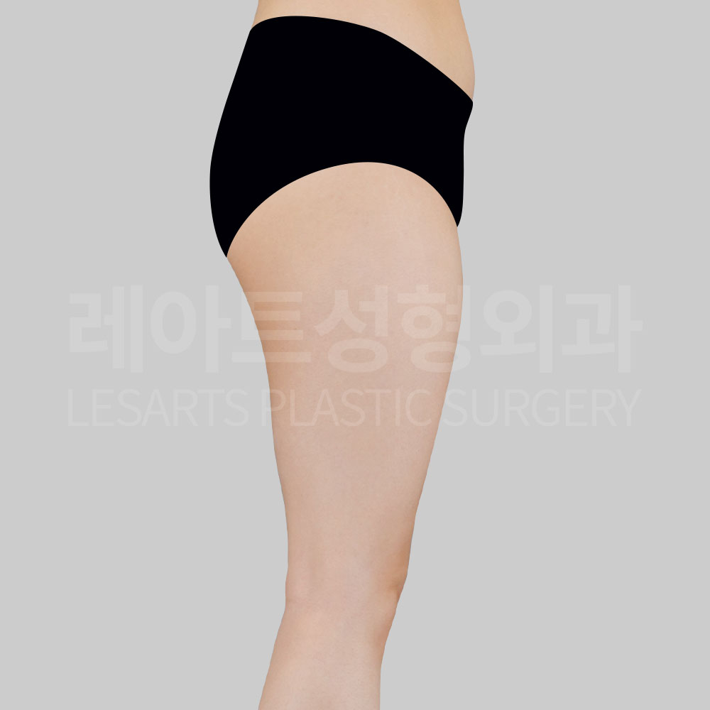 2_28695_thigh_liposuction_before4