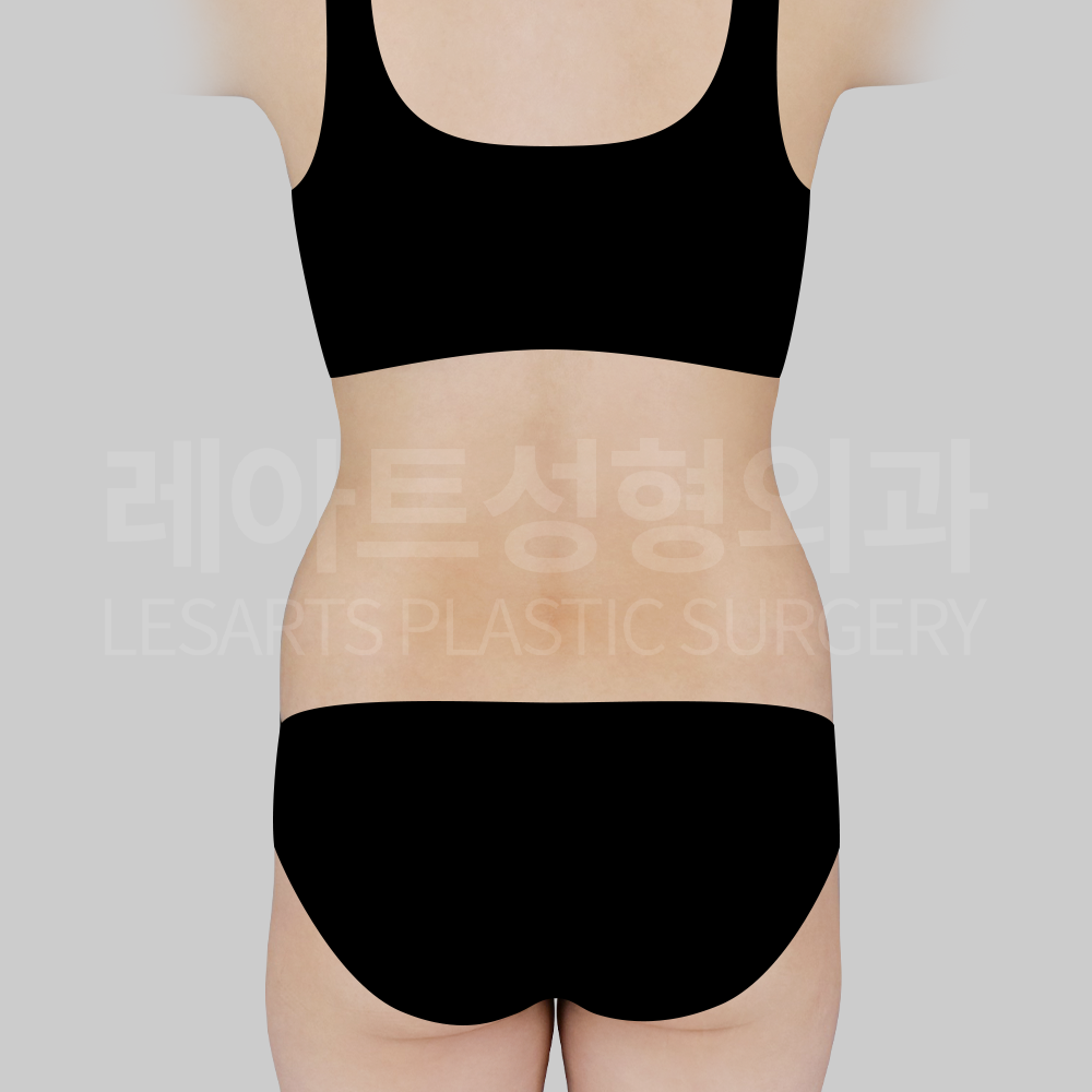 2_29214_abdominal_liposuction