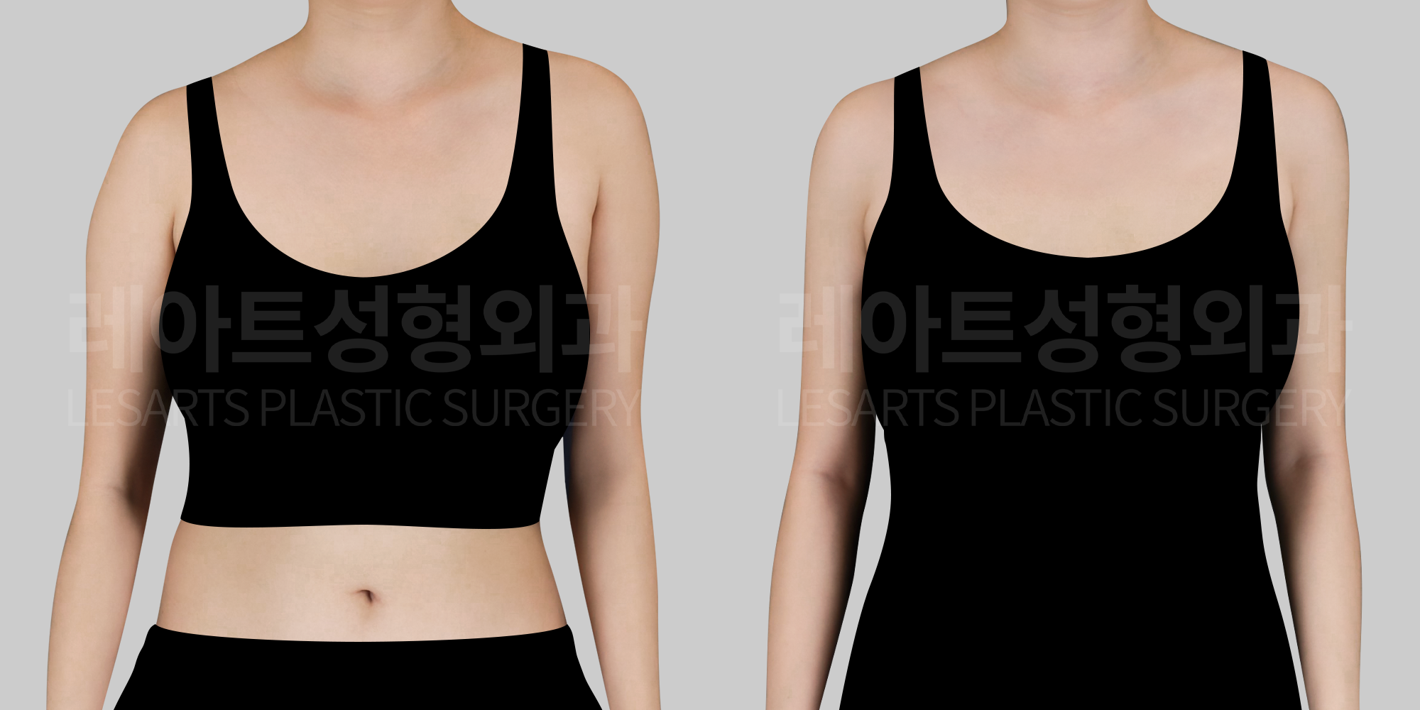 [Arm liposuction]Finding a customized arm line through liposuction instead of exercise