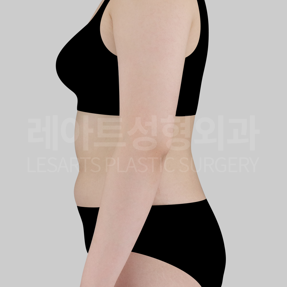 3.abdominal_liposuction_29377_side