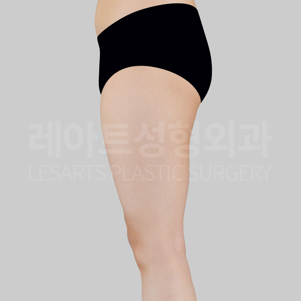 3_28695_thigh_liposuction_before5