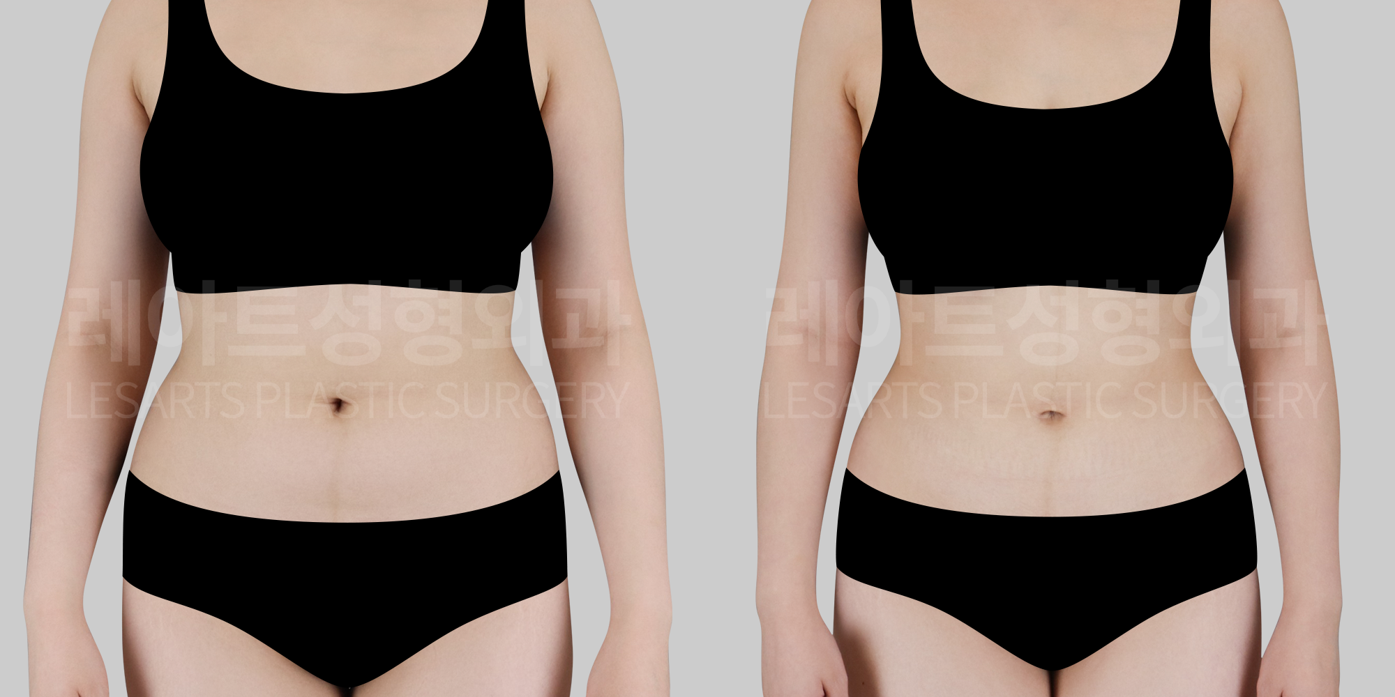 [Abdominal liposuction]An abdomen that gained weight rapidly.The secret to restoring a slim, delicate waistline