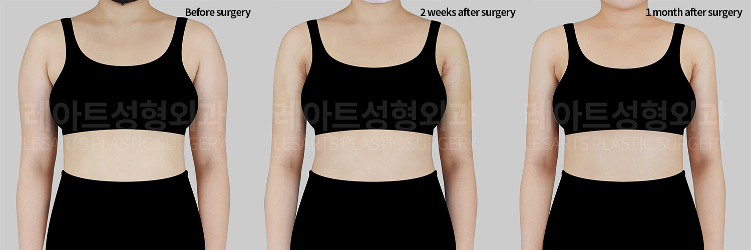 [Arm liposuction]How much swelling will have gone down one month after arm liposuction?