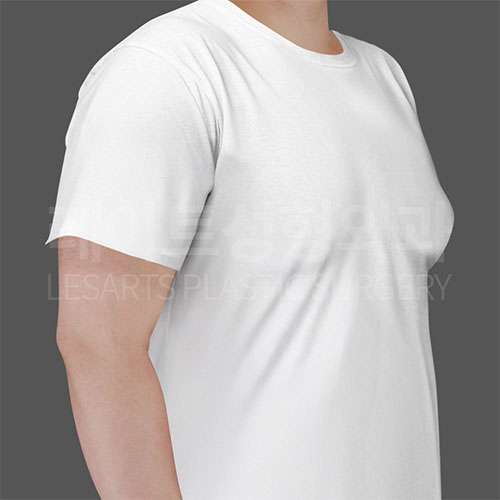 4-1_gynecomastia-_30268_before_t