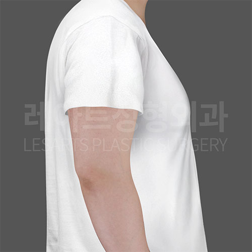 4-2_gynecomastia-_30268_before_t