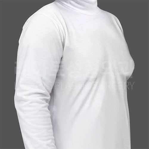 4-3_gynecomastia-_30268_before_t