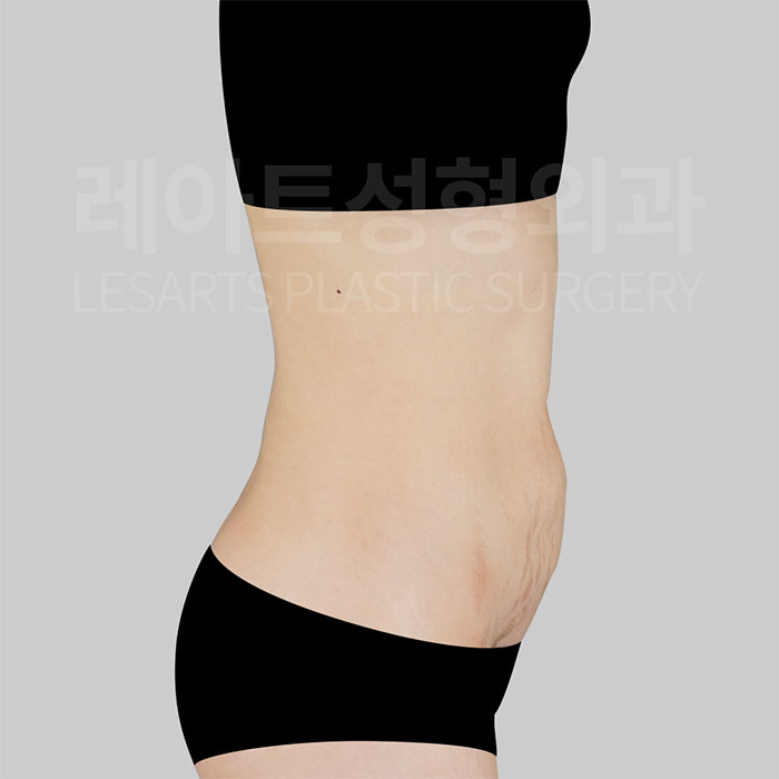 4-abdominoplasty-30075-before