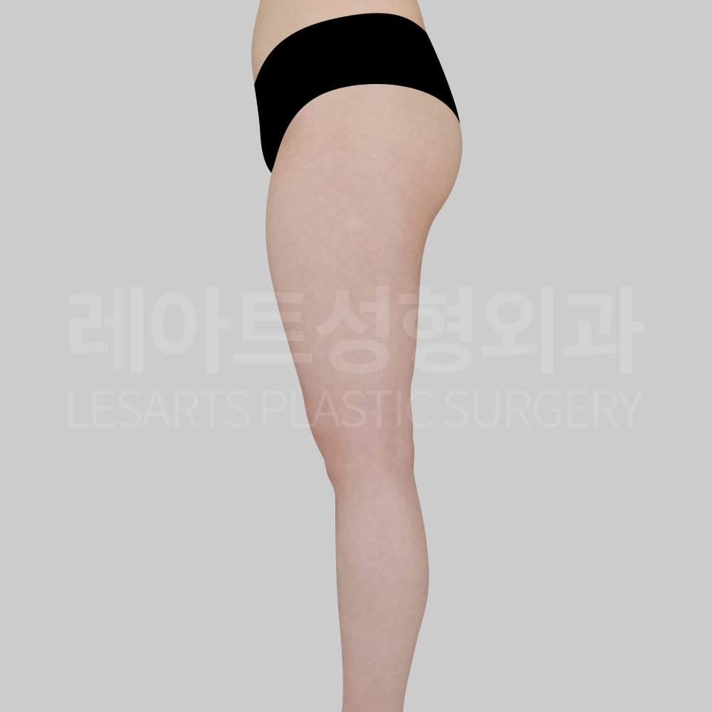 4.thigh_liposuction_29936_side