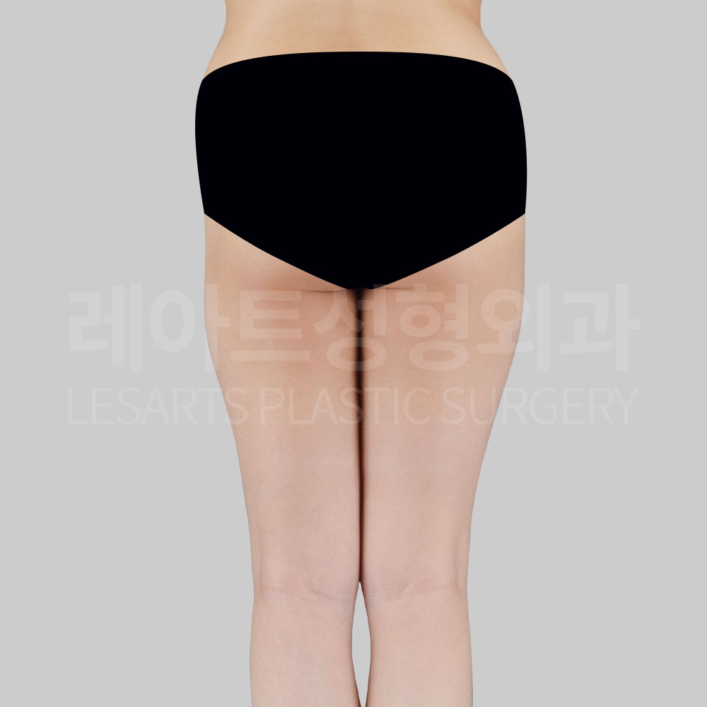 4_28695_thigh_liposuction_before6