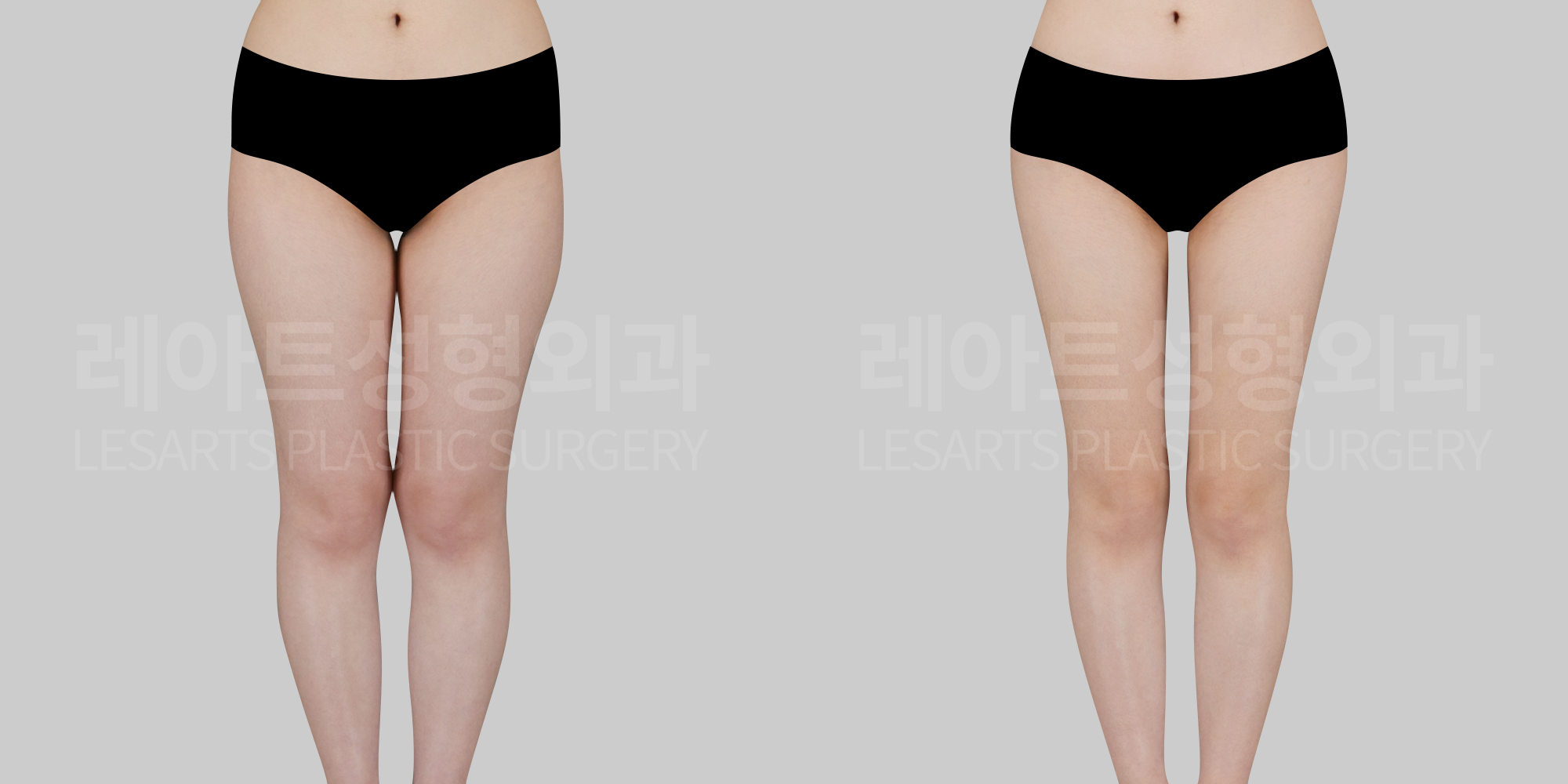 [Thigh liposuction]Is removing saddlebags enough? Overlooked design points in thigh liposuction