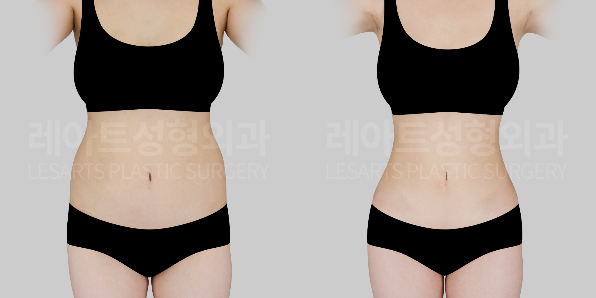 [Abdominal liposuction]Stop the Cycle of Repeated Yo-Yo! Discover Hidden Lines with Large-Volume Full-Body Abdominal Liposuction