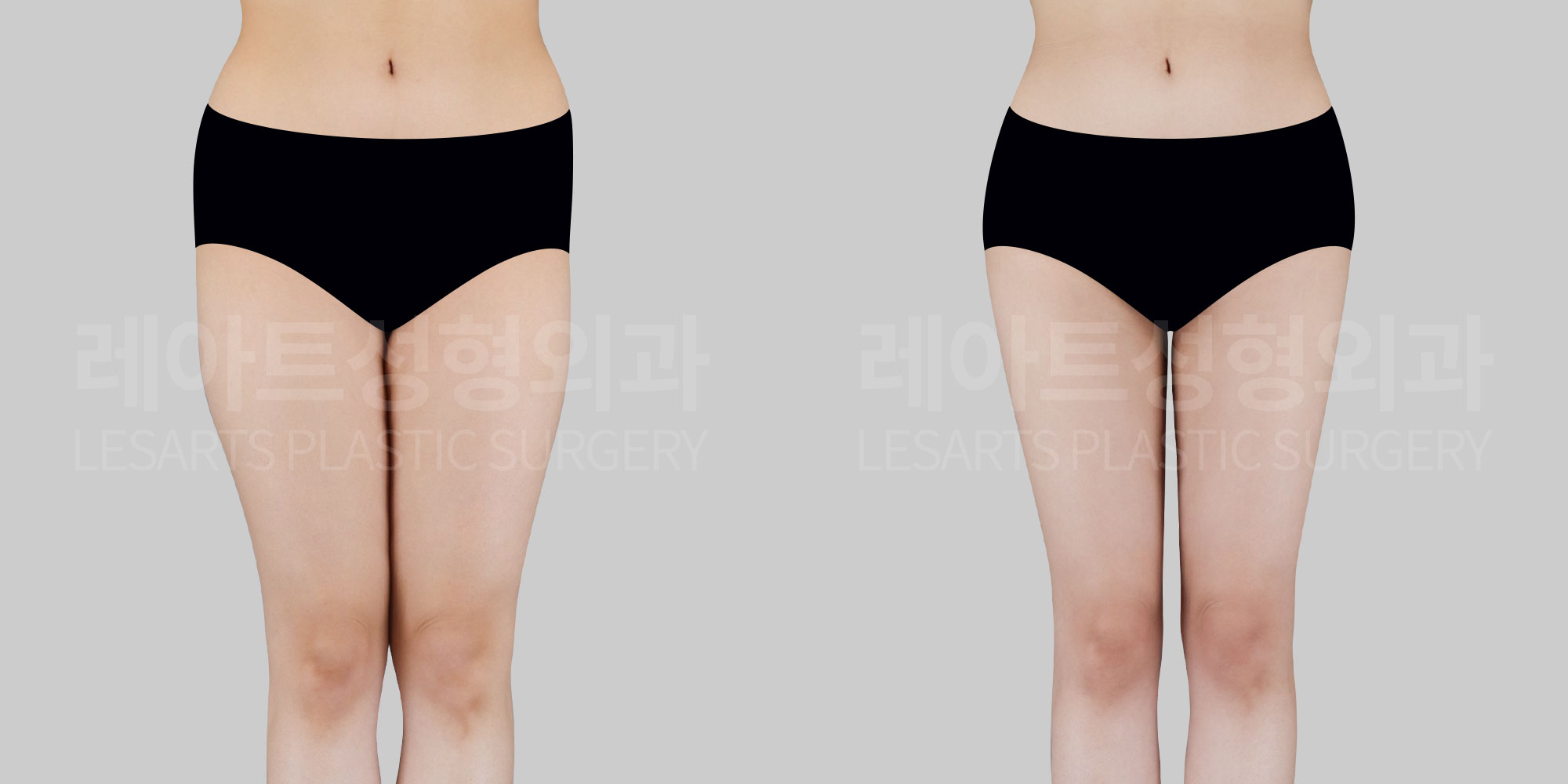 [Thigh liposuction + hip dip fat transfer]Create a beautiful S-line with hip dip fat transfer and thigh liposuction