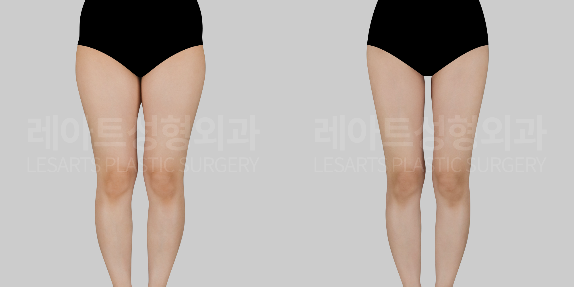 [Thigh liposuction] Can thigh liposuction improve an “O-shaped” inner-thigh line?