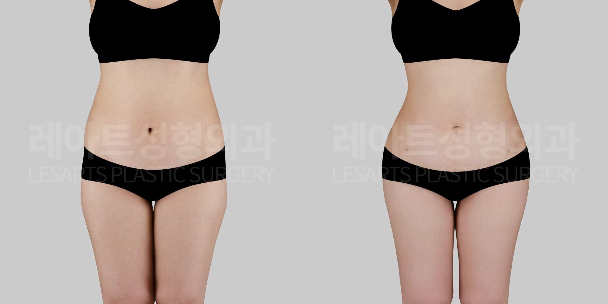 [Upper liposuction]Creating a smooth abdomen-to-pelvis curve: Why you look much slimmer even though your weight is the same
