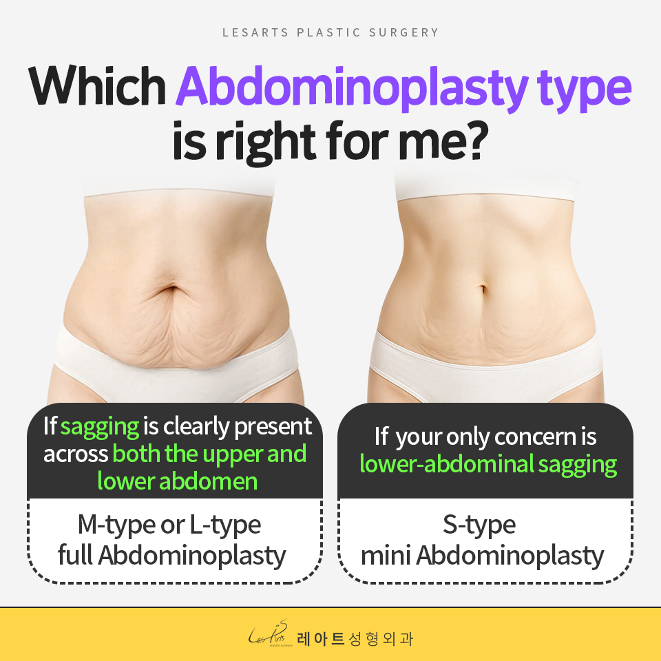 Abdominoplasty( Tummy tuck): S-type floating vs. M-type — which surgery do I need?