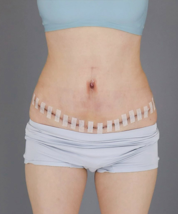UnniDOvQKF tummy tuck 2 weeks after surgery in Korea – Lesarts Plastic Surgery