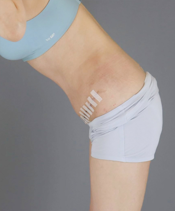 UnniDOvQKF tummy tuck before photo in Korea – Lesarts Plastic Surgery