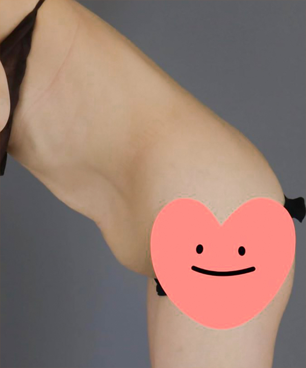 UnniDOvQKF tummy tuck before photo in Korea – Lesarts Plastic Surgery