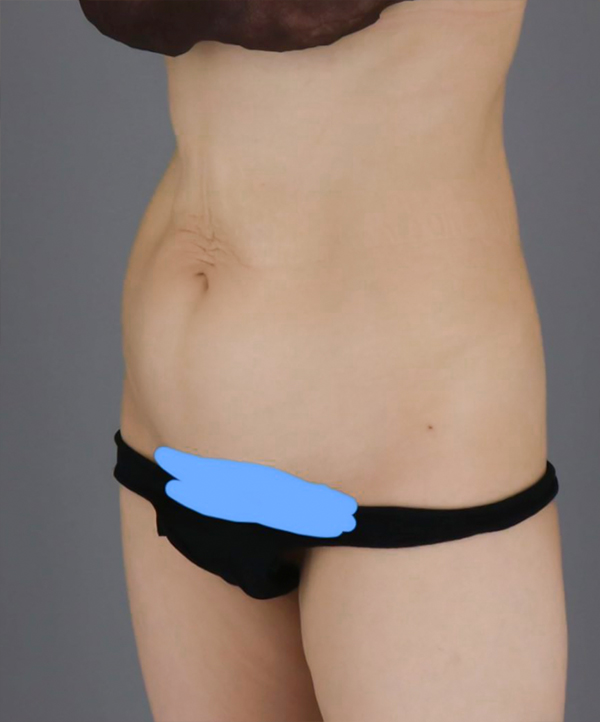 UnniDOvQKF tummy tuck before photo in Korea – Lesarts Plastic Surgery
