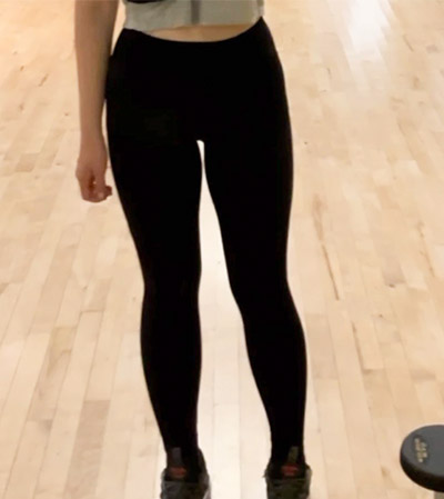 UnniECSZII thigh and calf liposuction before photo in Korea – Lesarts Plastic Surgery