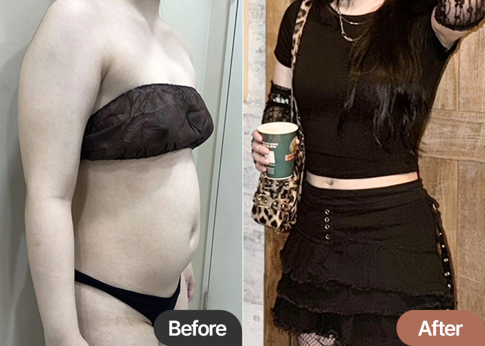 Abdominal Liposuction & Arm  Liposuction 2-Month Review in Korea – Natural Lines at Lesarts Plastic Surgery