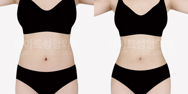 abdominal_liposuction_01_thumbnail_250909